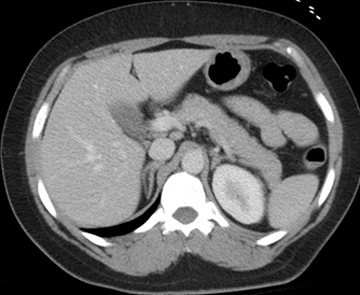 Abdomen CT