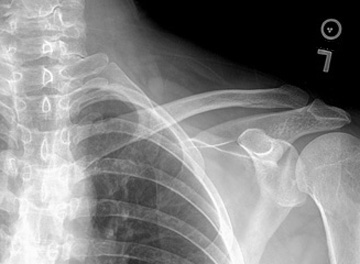 AP Clavicle