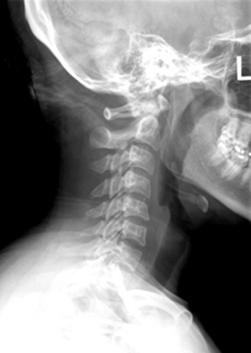 Lateral C-Spine