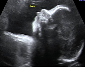 US Fetal Profile